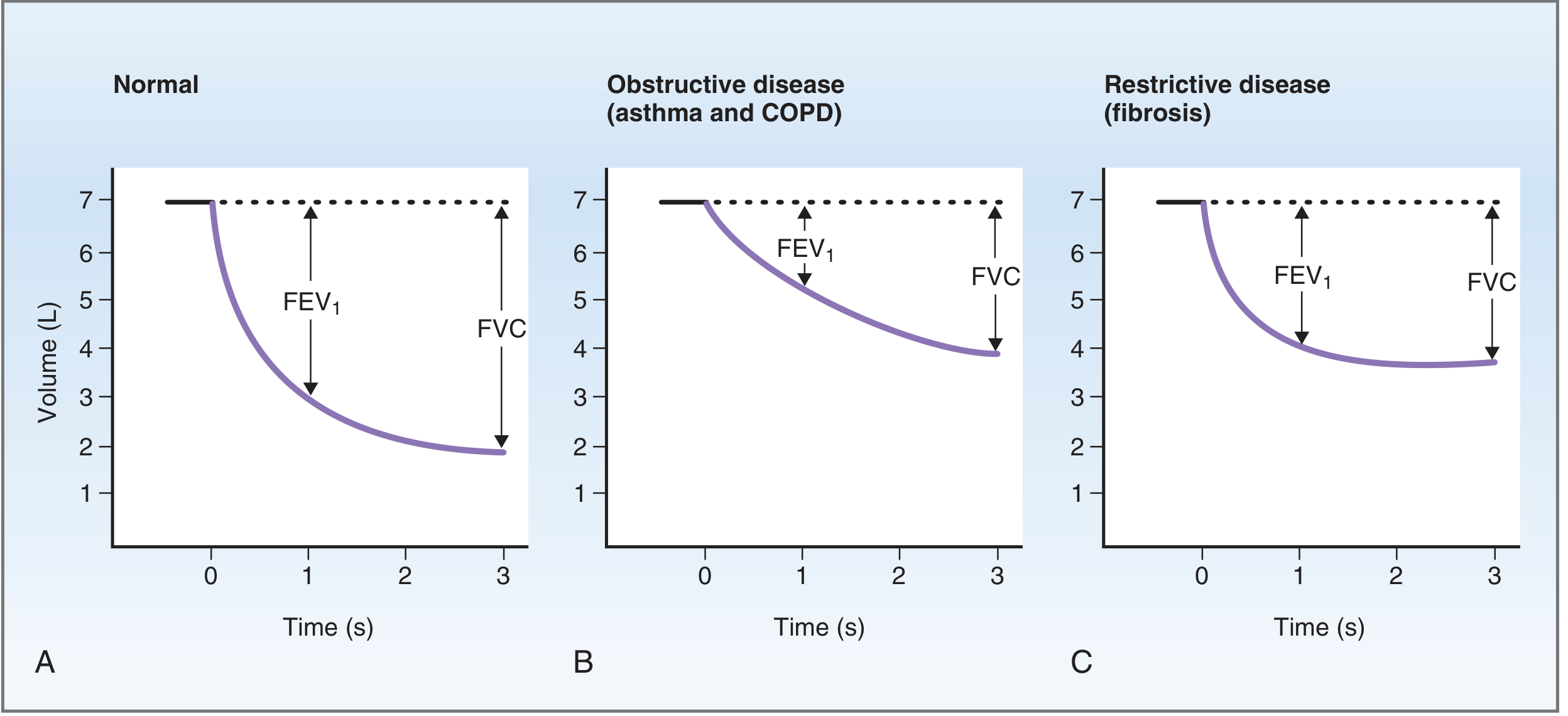 FVC and FEV1 patterns in normal, obstructive, and restrictive disease