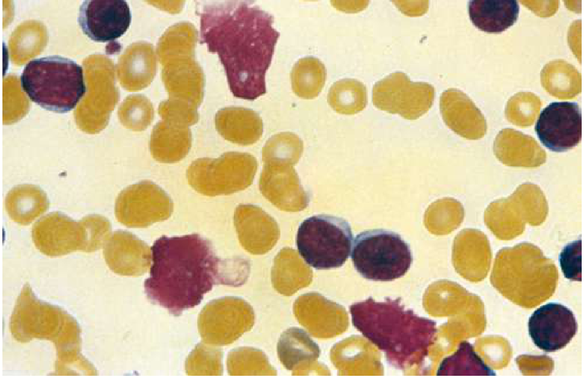 CLL peripheral smear - predominant mature-appearing lymphocytes with occasional smudge/basket cells - Goldman-Cecil Medicine