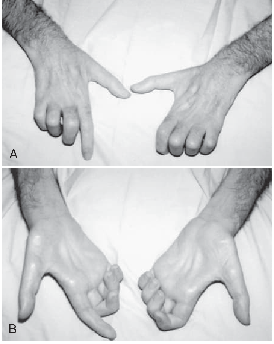 Severe intrinsic hand muscle atrophy in ALS, showing claw hand deformity affecting muscles innervated by both ulnar and median nerves