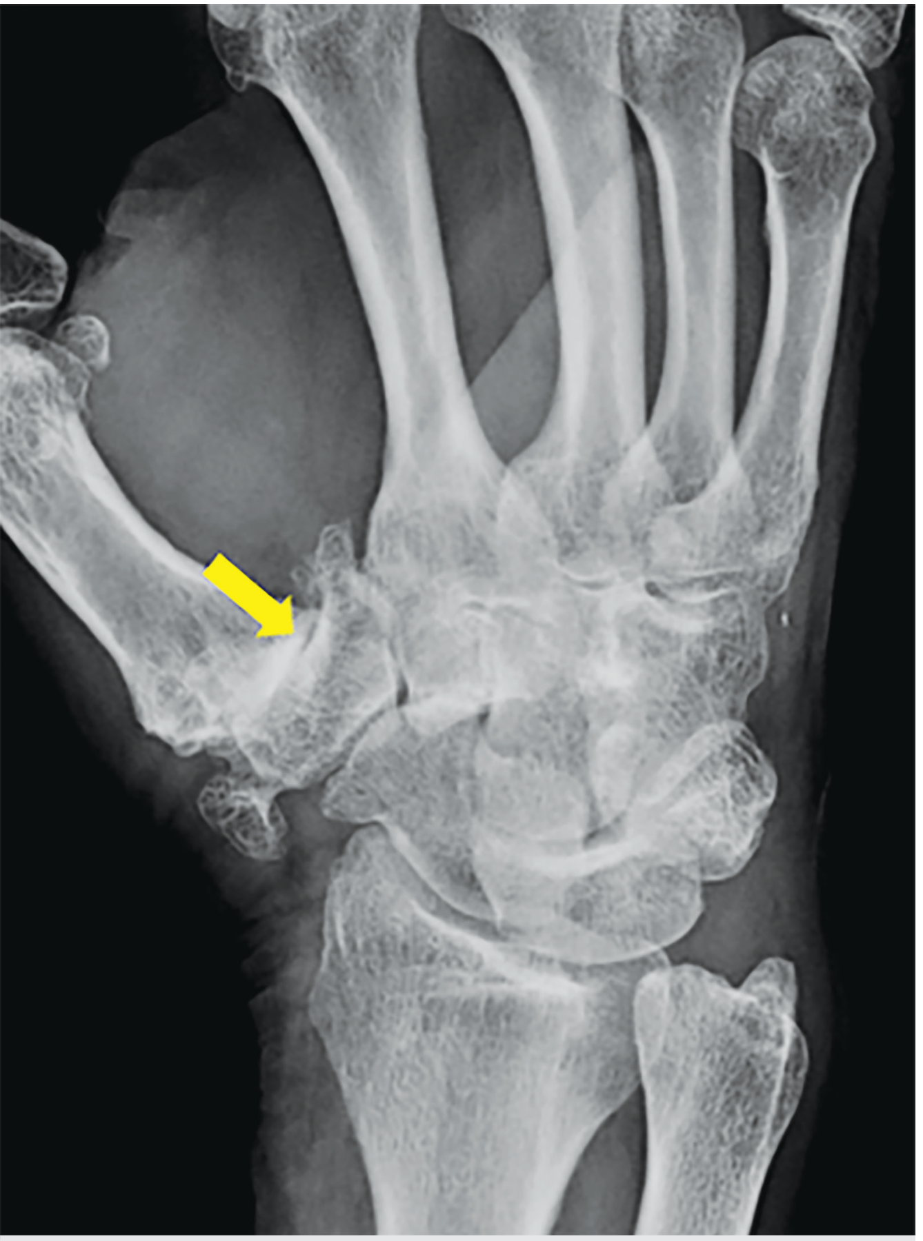 X-ray of advanced 1st CMC joint OA showing osteophytes and severe joint space narrowing