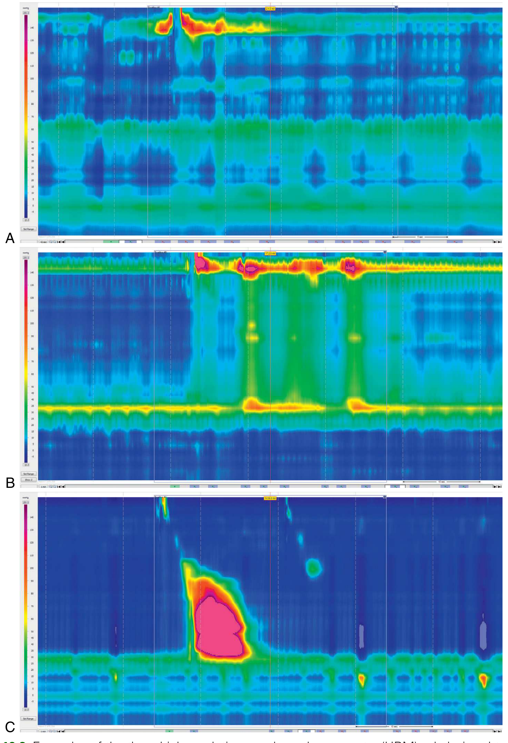 HRM achalasia subtypes A=Type I, B=Type II, C=Type III