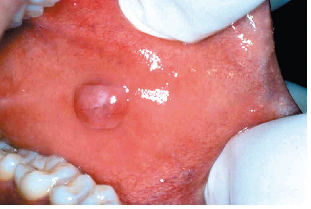 Fig. 16.2 - Irritation fibroma: Smooth pink exophytic nodule on the buccal mucosa