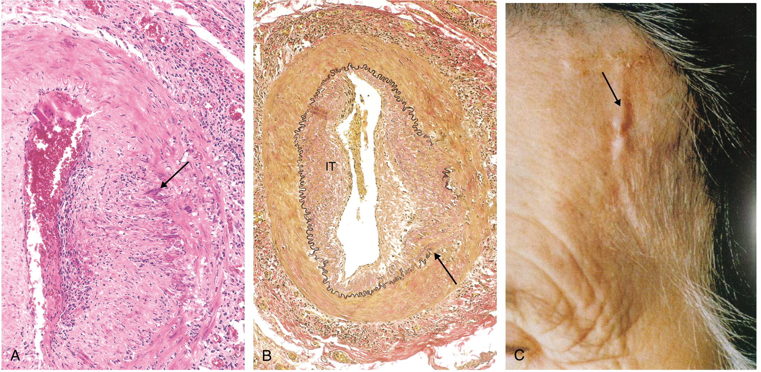 Giant cell arteritis histology (identical to TA): A - H&E showing giant cells and degenerated internal elastic membrane; B - elastic stain showing focal destruction and intimal thickening (IT); C - thickened, nodular temporal artery in patient
