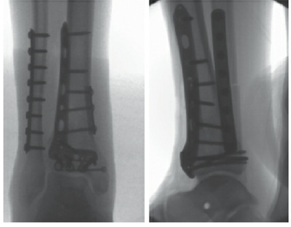 Post-ORIF AP and lateral X-rays showing medial tibial plate and fibular fixation after pilon fracture