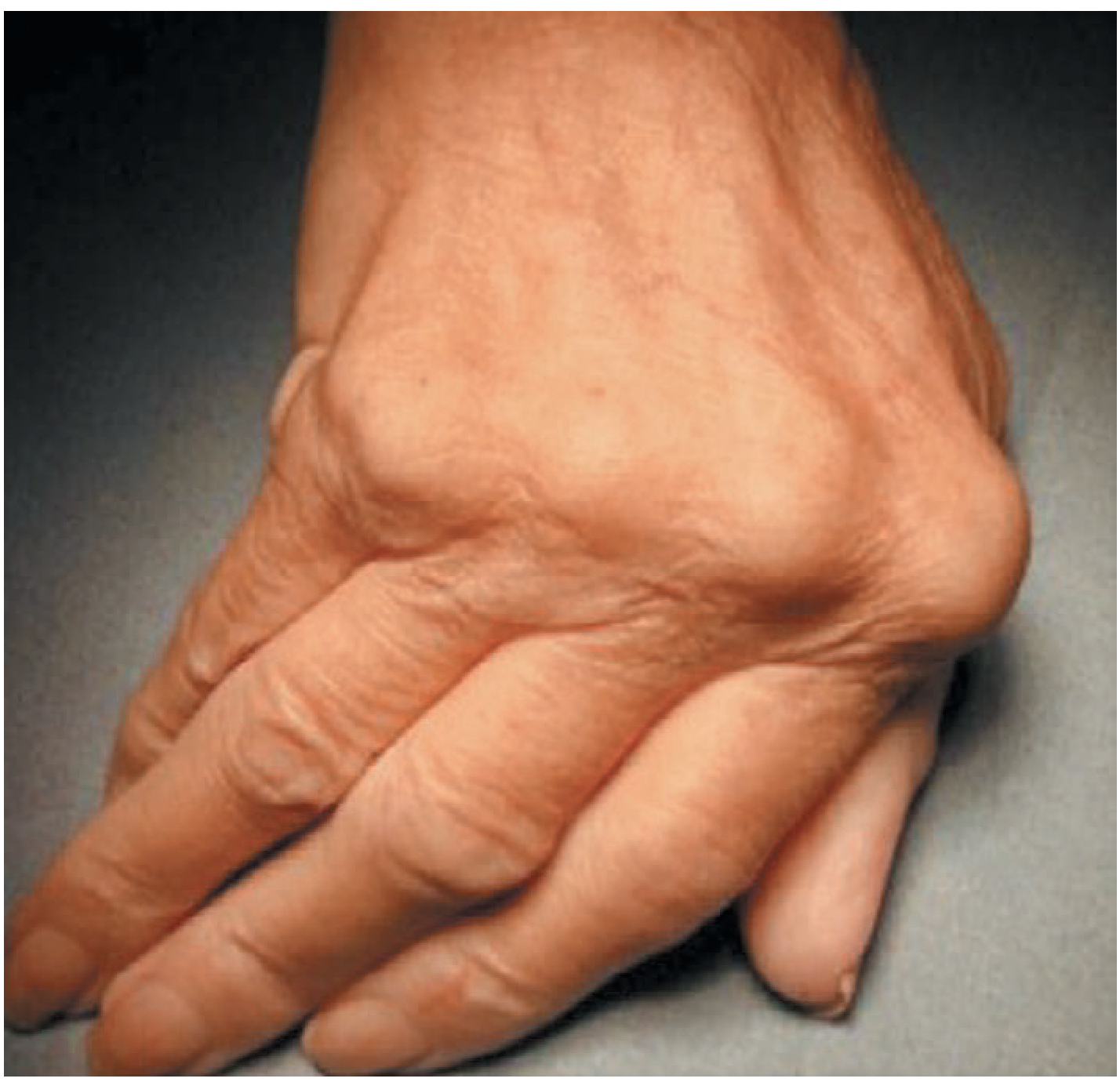 Rheumatoid hand ulnar drift