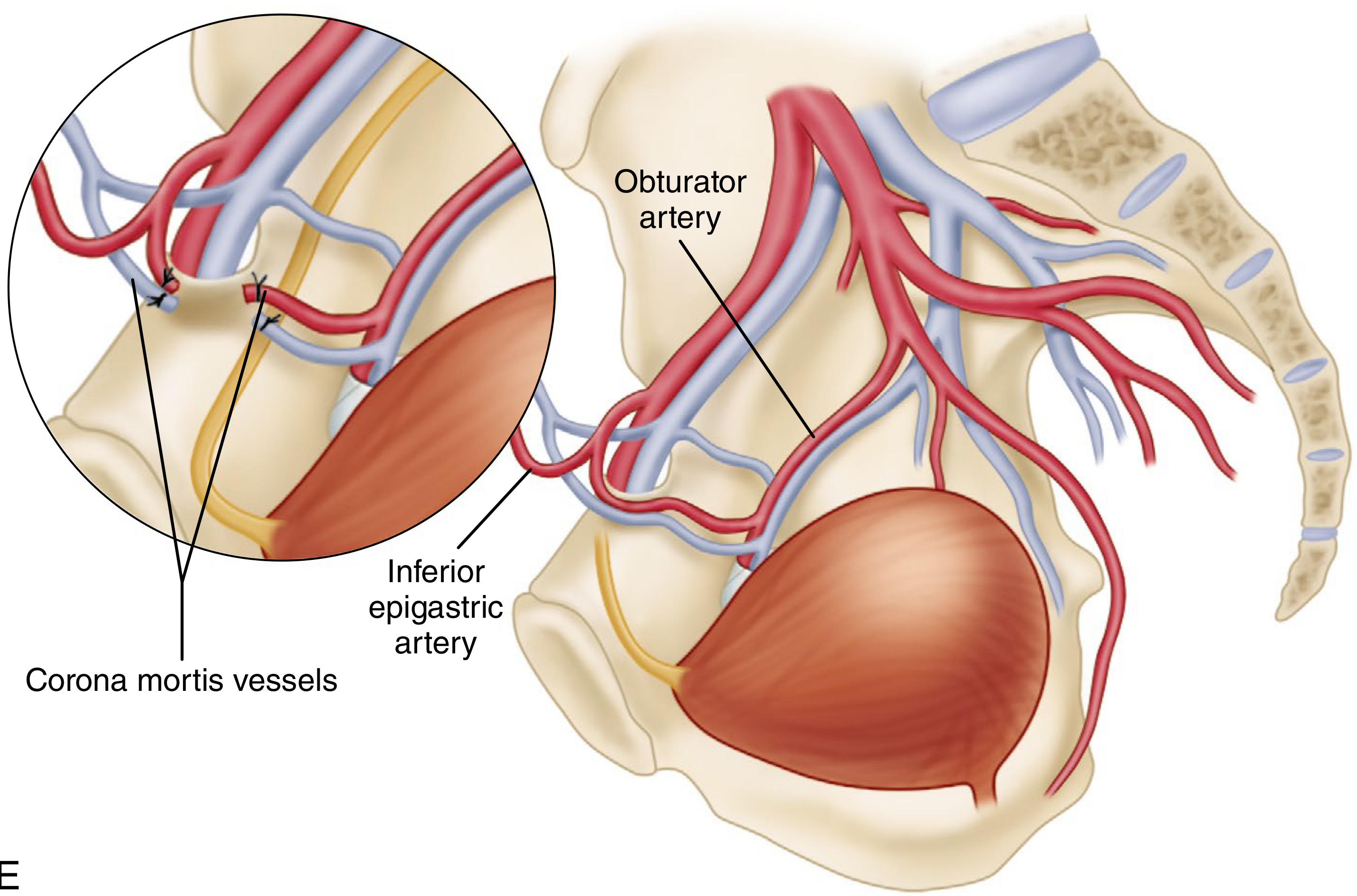 Corona mortis anatomy - anastomosis between inferior epigastric and obturator vessels, ligated inset