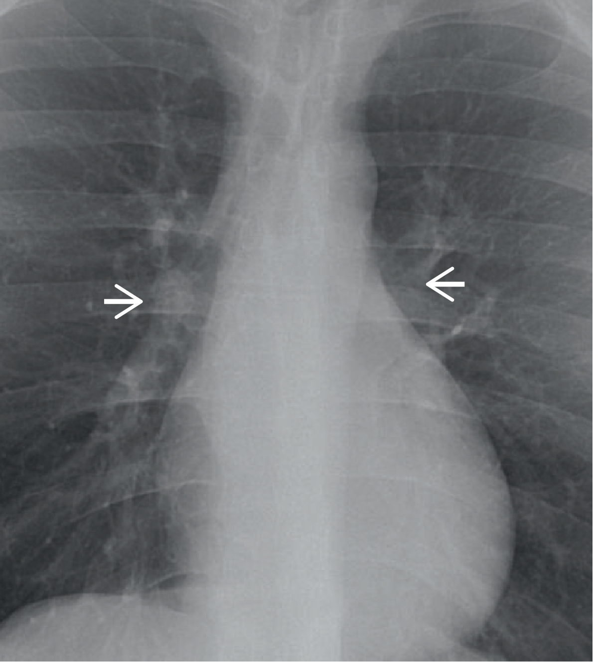 Bilateral enlarged hila from pulmonary hypertension - Grainger & Allison's