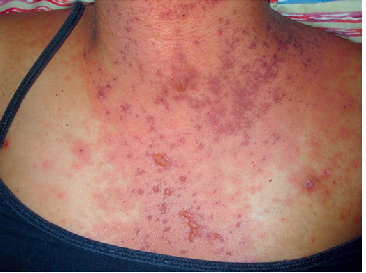 Widespread erythematous morbilliform rash across the chest and neck in a patient with acute GVHD