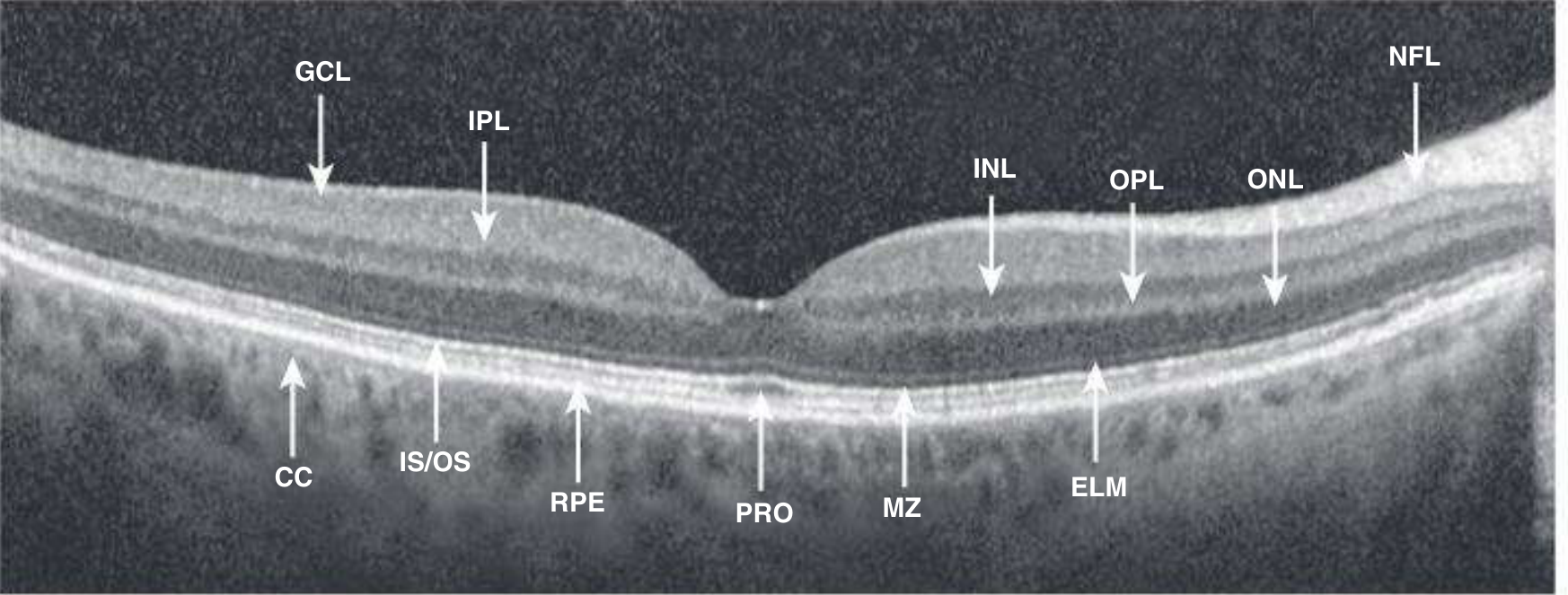 Normal SD-OCT of the retina with labeled layers - GCL, IPL, INL, OPL, ONL, ELM, IS/OS, PRO, RPE, CC, NFL