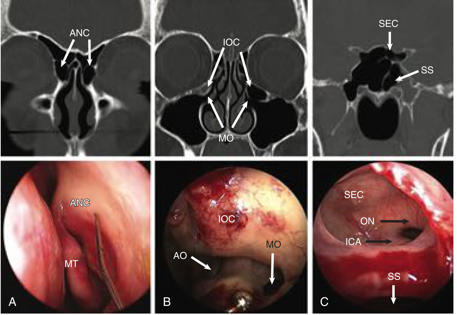 Fig 44.5 top row CT scans: (A) agger nasi cell (ANC) anterior to middle turbinate (MT); (B) infraorbital ethmoidal cells (IOC / Haller cells) narrowing the infundibulum with maxillary ostium (MO); (C) sphenoethmoidal cell (SEC / Onodi cell) lateral and superior to sphenoid sinus (SS). Bottom row shows corresponding endoscopic views including optic nerve (ON) and internal carotid artery (ICA) in relation to SEC