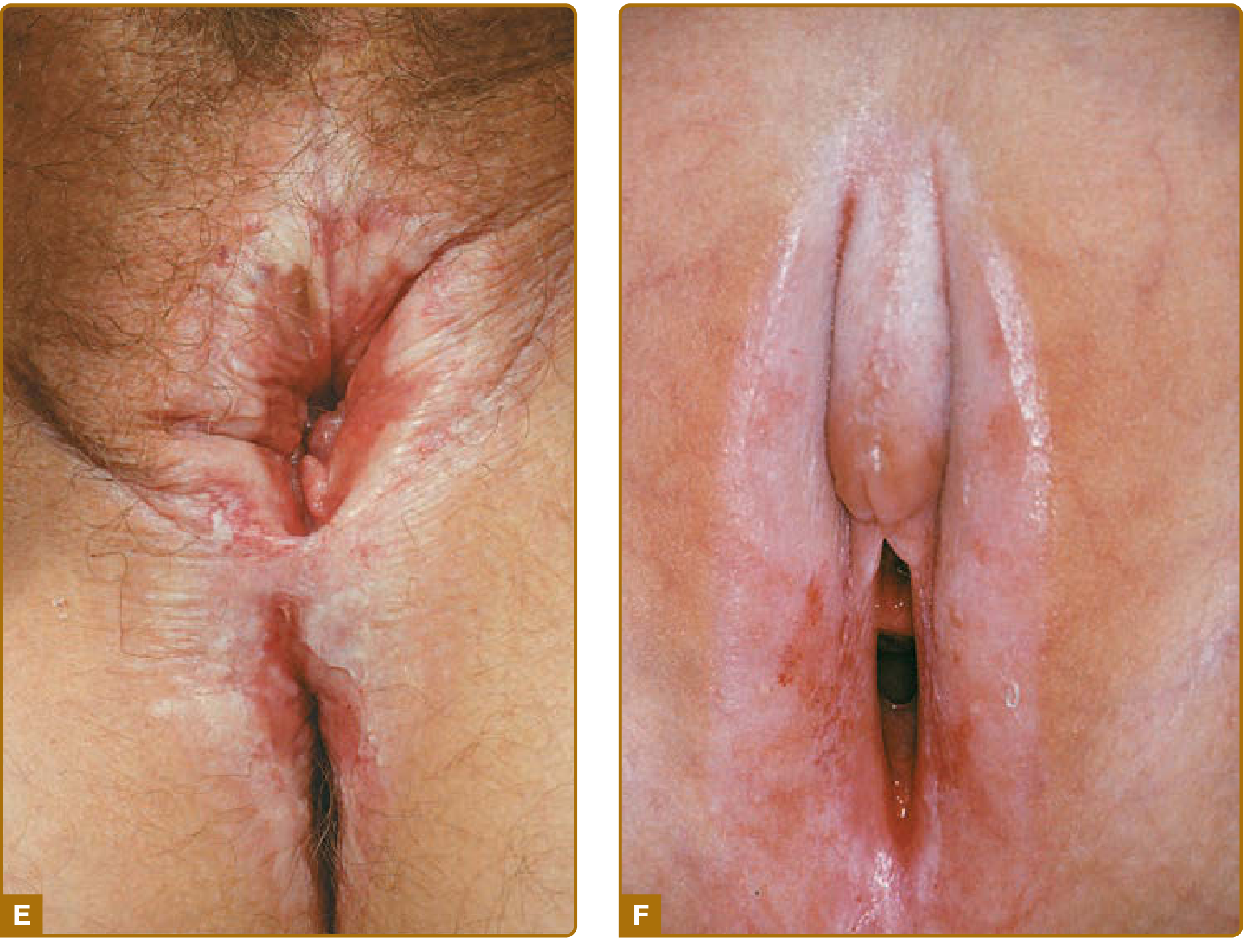 Lichen sclerosus - figure-8 pattern, loss of labia minora, stenosis; and pediatric lichen sclerosus