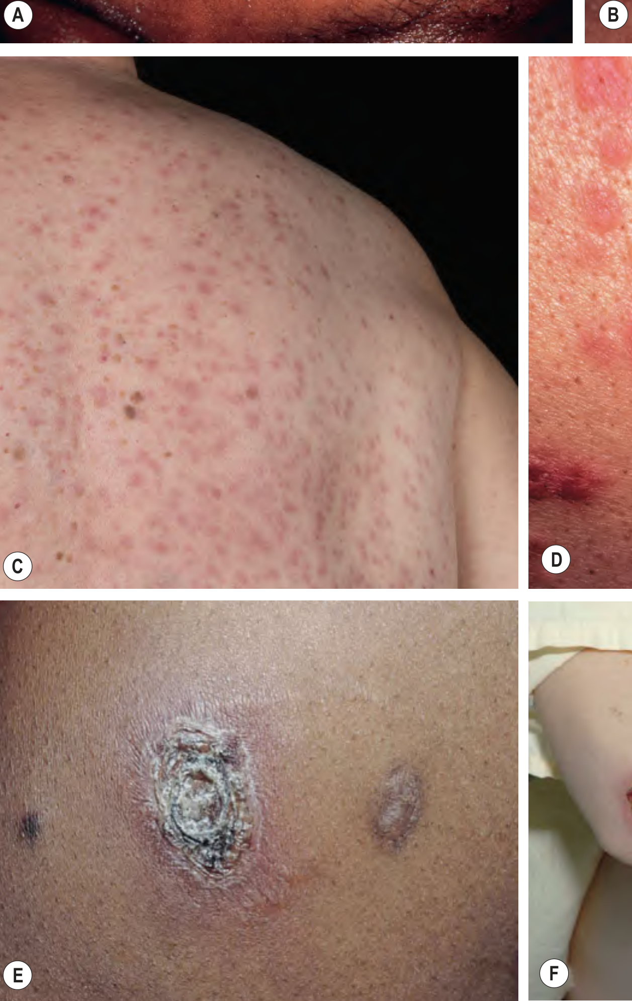 Less common manifestations of secondary syphilis including malignant syphilis lesions (E: necrotic lesion with scale-crust; F: multiple necrotic, ulcerated and crusted lesions)