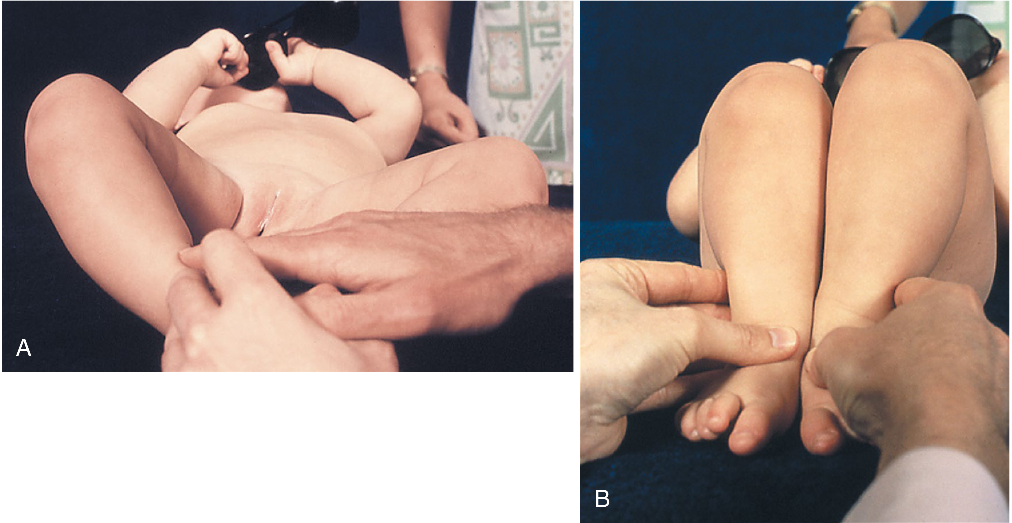 Clinical signs of DDH - decreased abduction (A) and Galeazzi sign (B)