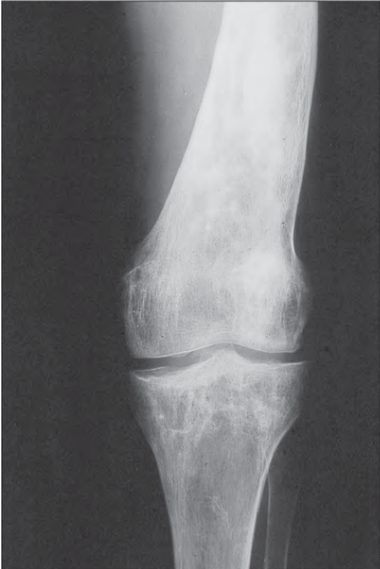 X-ray of Erlenmeyer flask deformity - distal femur showing expansion of cortical contour, cortical thinning and loss of normal concavity - typical but not pathognomonic for Gaucher disease