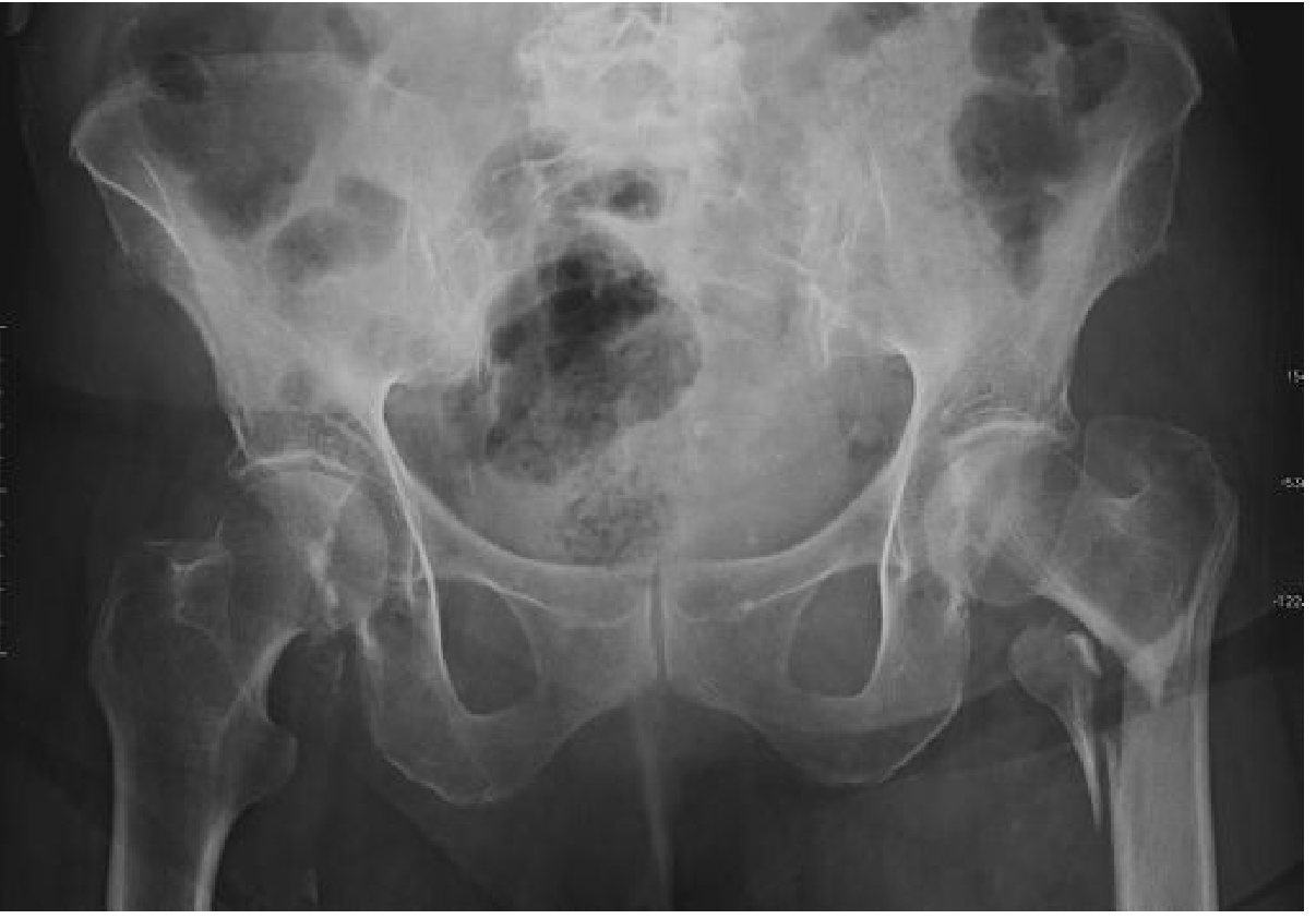 Comminuted intertrochanteric fracture on the left (AP pelvis X-ray)