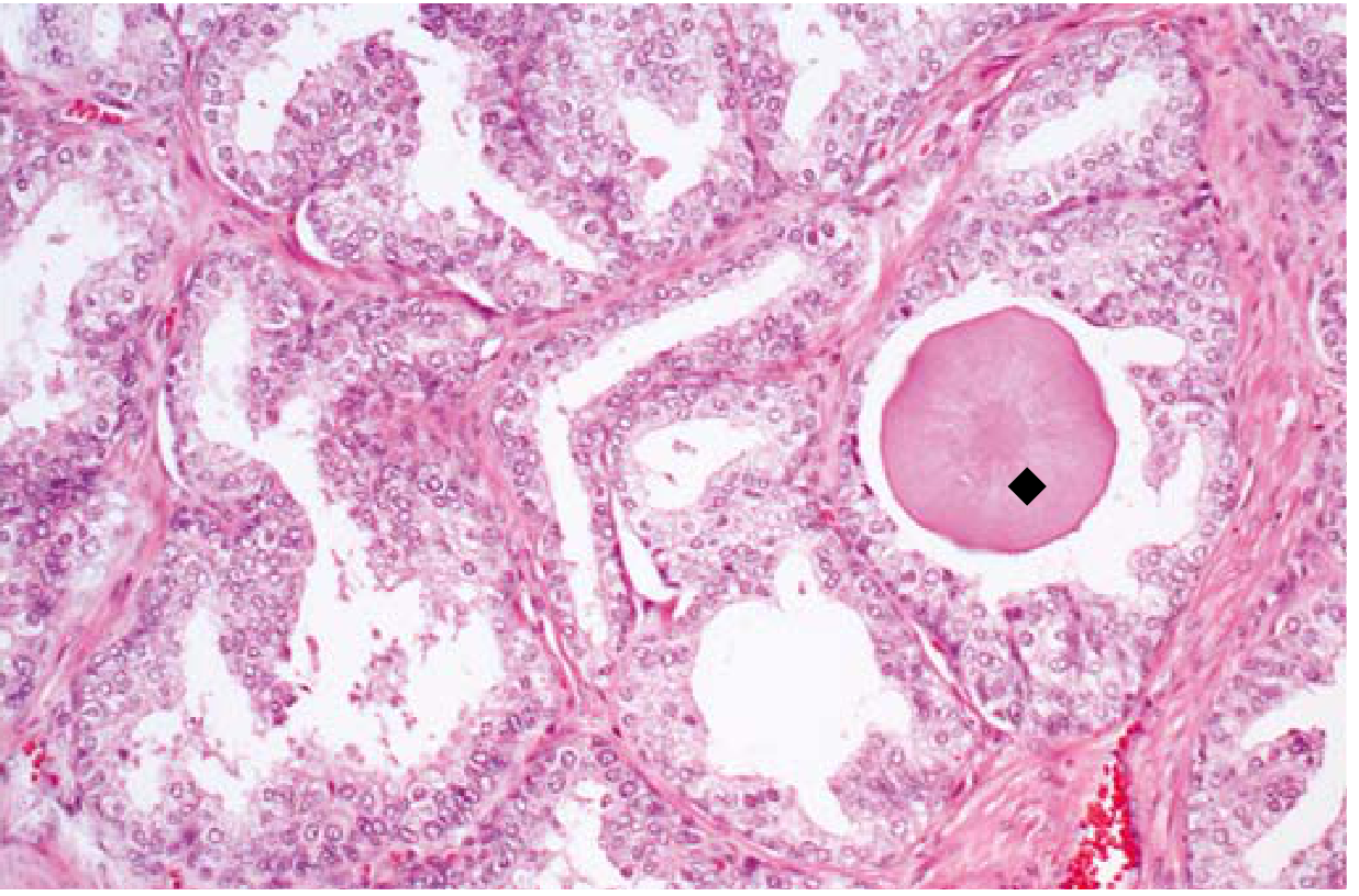 BPH with corpora amylacea (black diamond) - rounded pink concretion in a glandular lumen