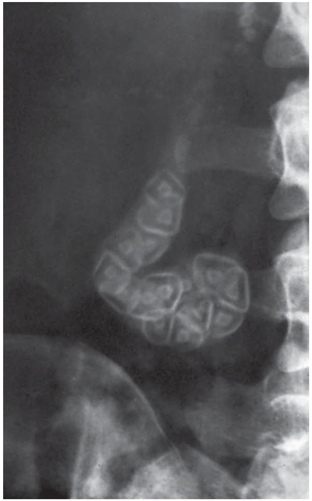 Plain radiograph showing radio-opaque gallstones with triradiate and biradiate radiolucent gas fissures - the Mercedes-Benz and seagull signs - Bailey & Love Figure 71.4