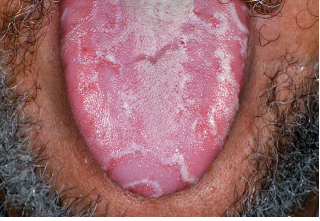 Geographic tongue - multiple erythematous well-demarcated depapillated patches with white-yellow serpiginous borders creating map-like appearance on tongue