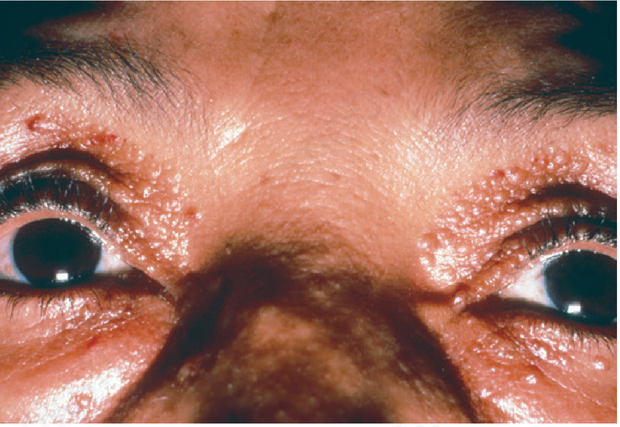Periorbital waxy papules and hemorrhagic lesions in AL amyloidosis (Andrews' Fig. 26.1)