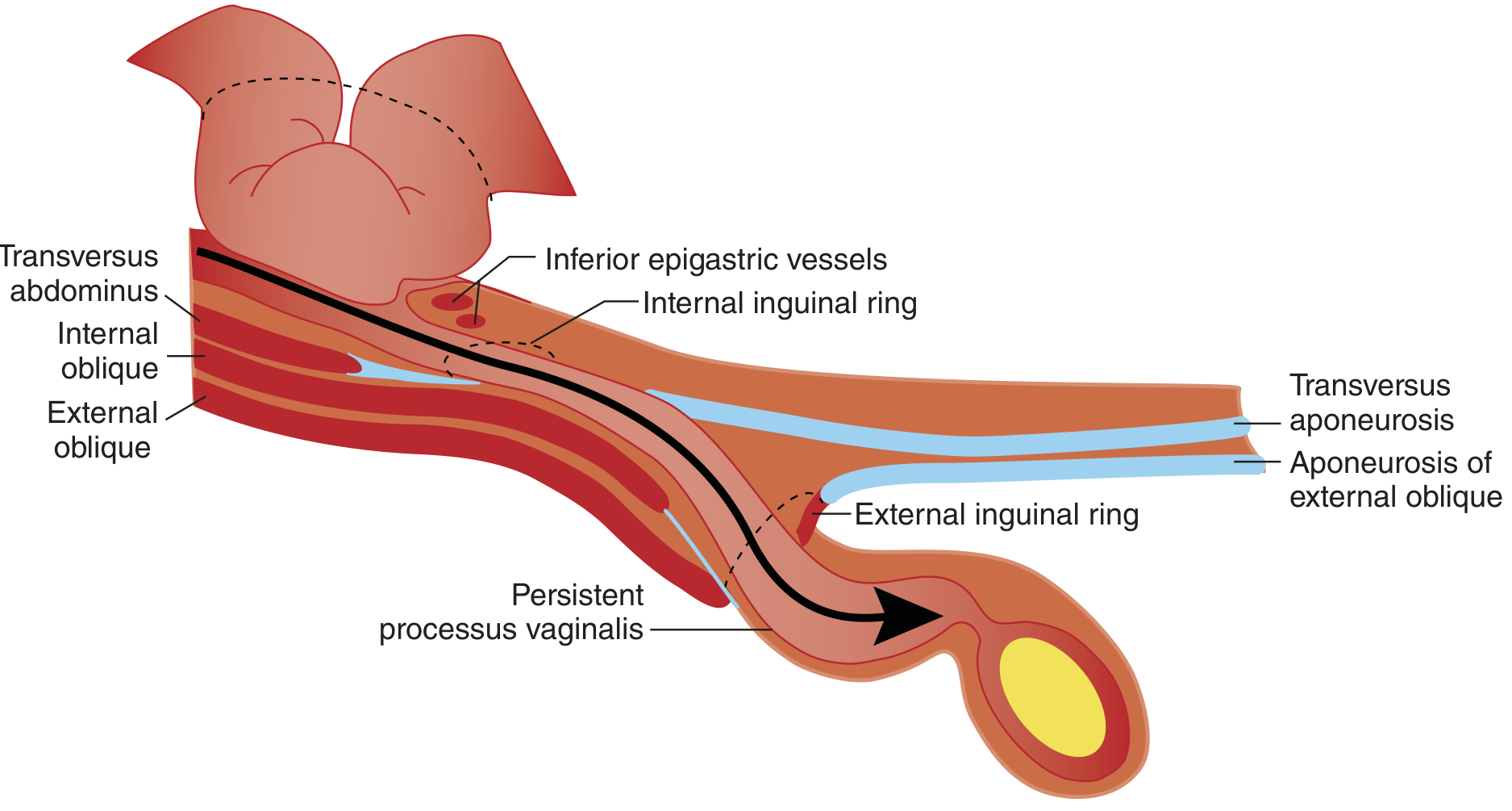Cross-sectional diagram of indirect inguinal hernia showing path through internal ring via persistent processus vaginalis