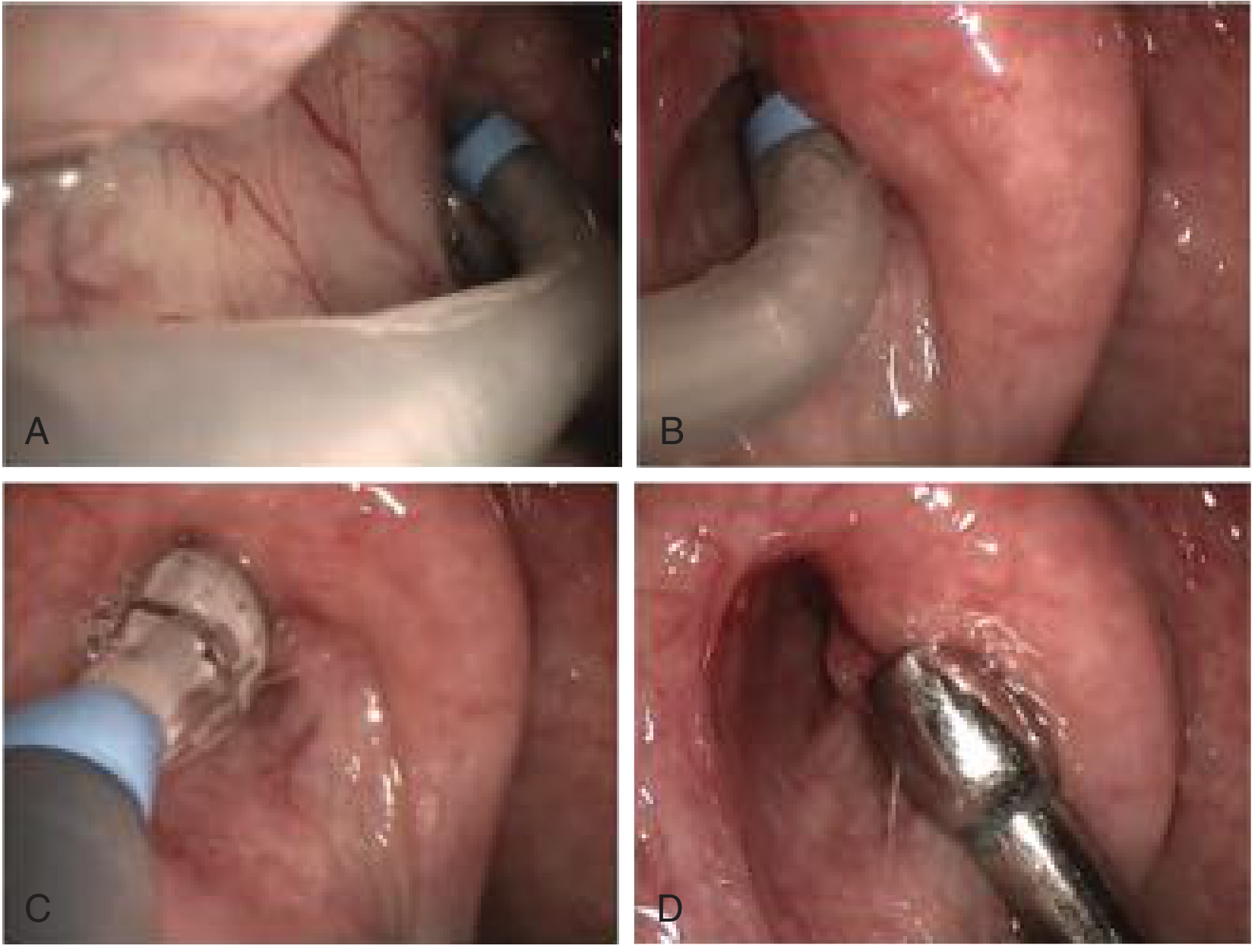 Intraoperative endoscopic images showing balloon catheter advancement, inflation at the isthmus, and post-dilation lumen inspection
