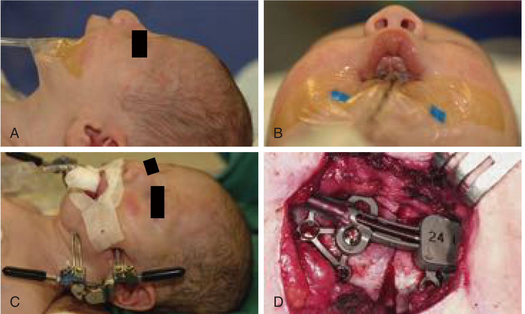 Craniofacial distraction osteogenesis — neonatal mandible (Pierre Robin sequence) with external and internal distractors