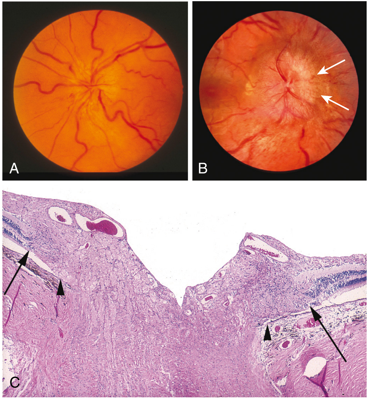 AION vs papilledema — fundoscopy and histology showing pale swollen disc in AION (A/B) vs hyperemic disc in papilledema, with histological termination of Bruch membrane (C)