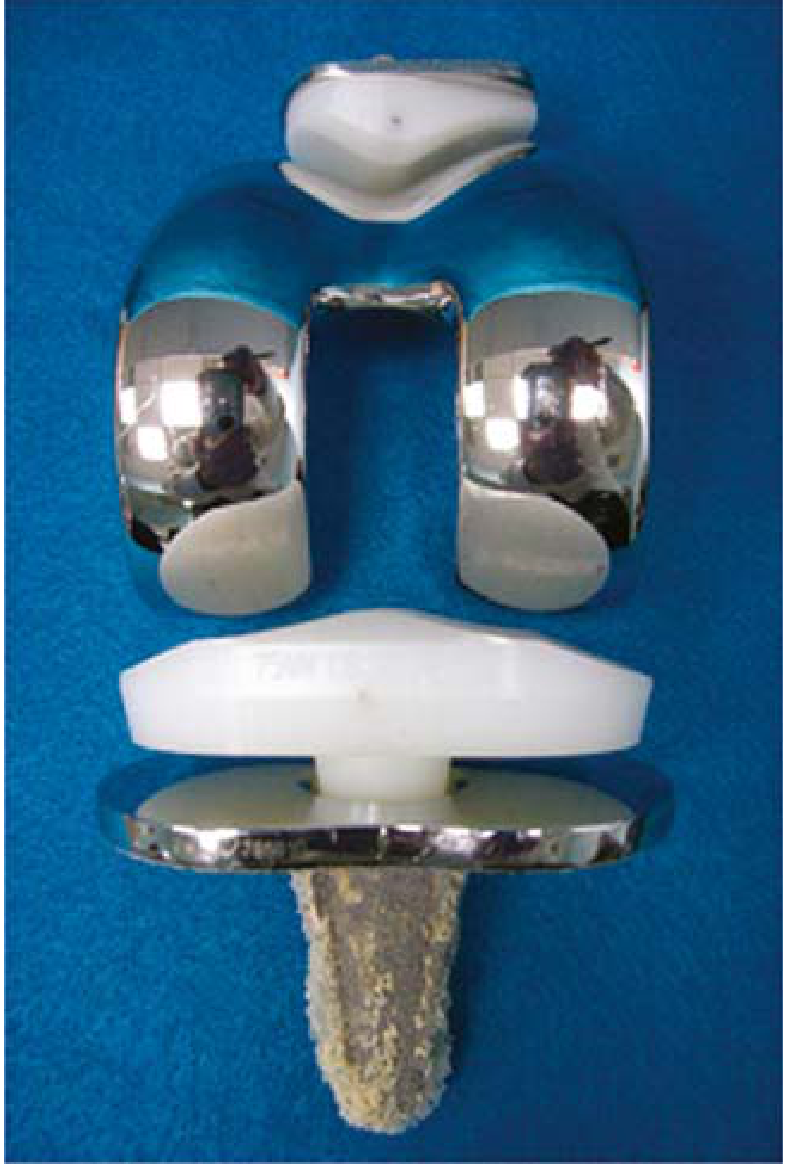 TKA components showing tibial baseplate (bottom, metal tray with stem) and PE insert (white, above it), along with the femoral component and patellar button