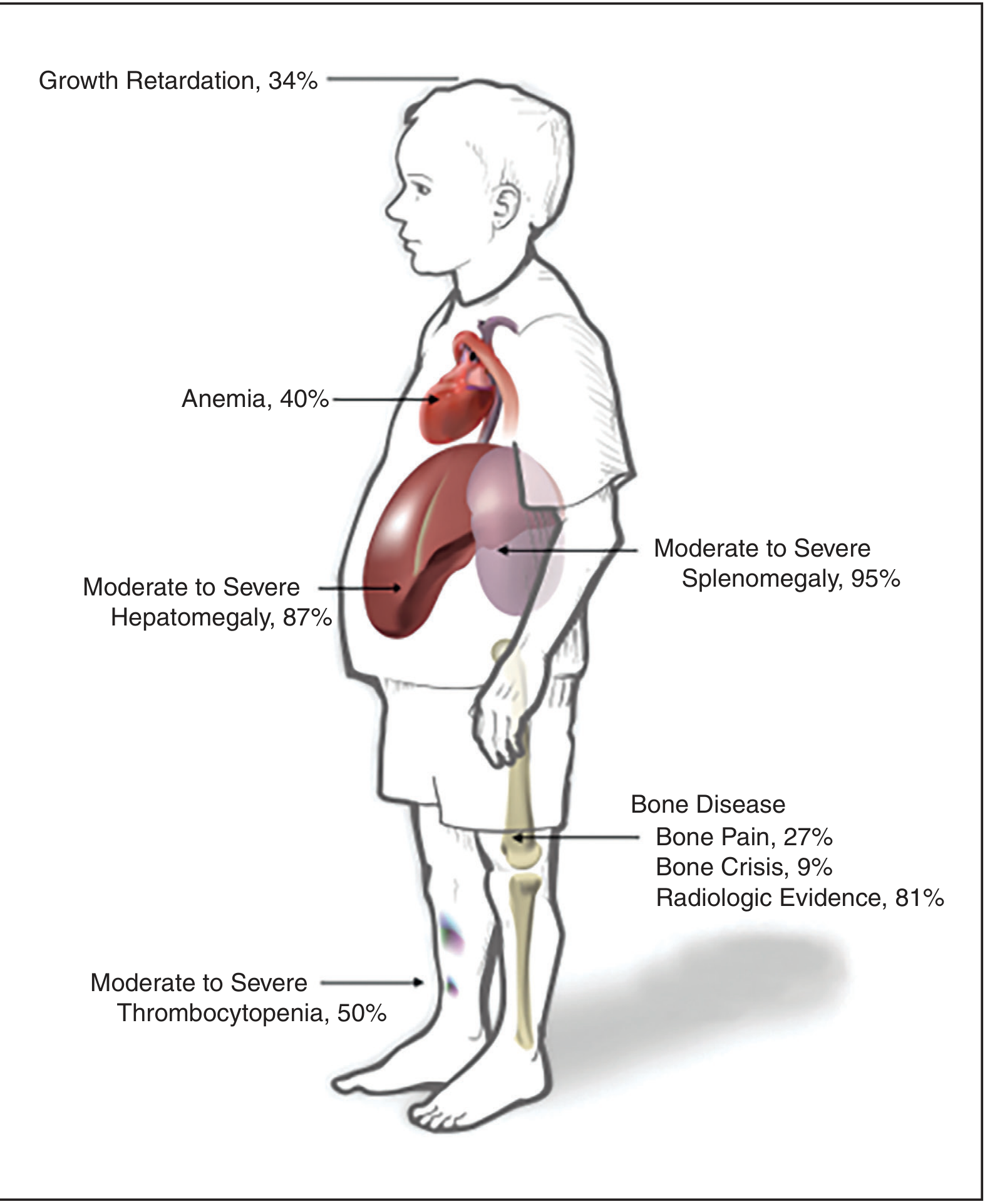 Gaucher disease organ involvement in children