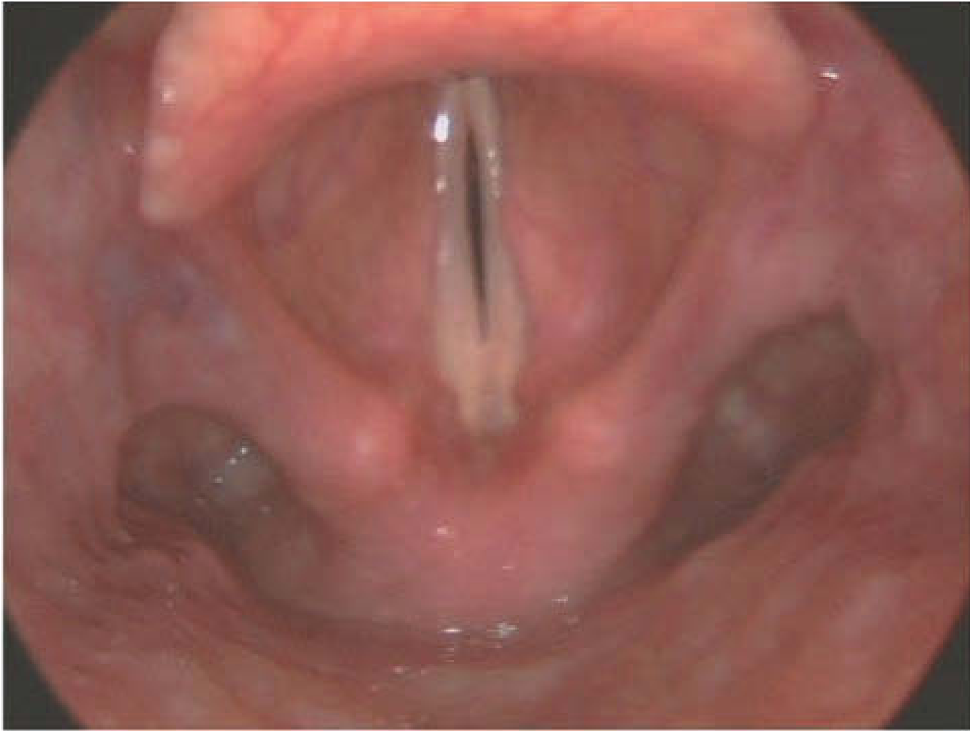 MTD laryngoscopy - one pattern of muscle tension seen (Scott-Brown's)
