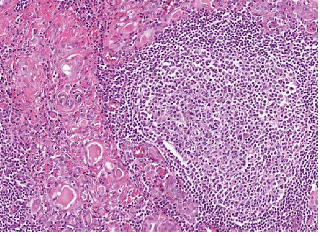 Hashimoto thyroiditis histology - dense lymphocytic infiltrate with germinal centre formation and atrophic follicles