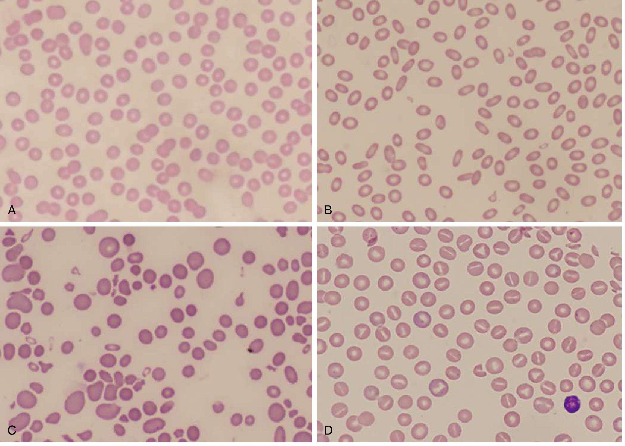 Peripheral blood smears: Panel A shows hereditary spherocytosis with characteristic small, dense, round spherocytes lacking central pallor; Panel B shows hereditary elliptocytosis; Panel C shows hereditary pyropoikilocytosis; Panel D shows hereditary stomatocytosis