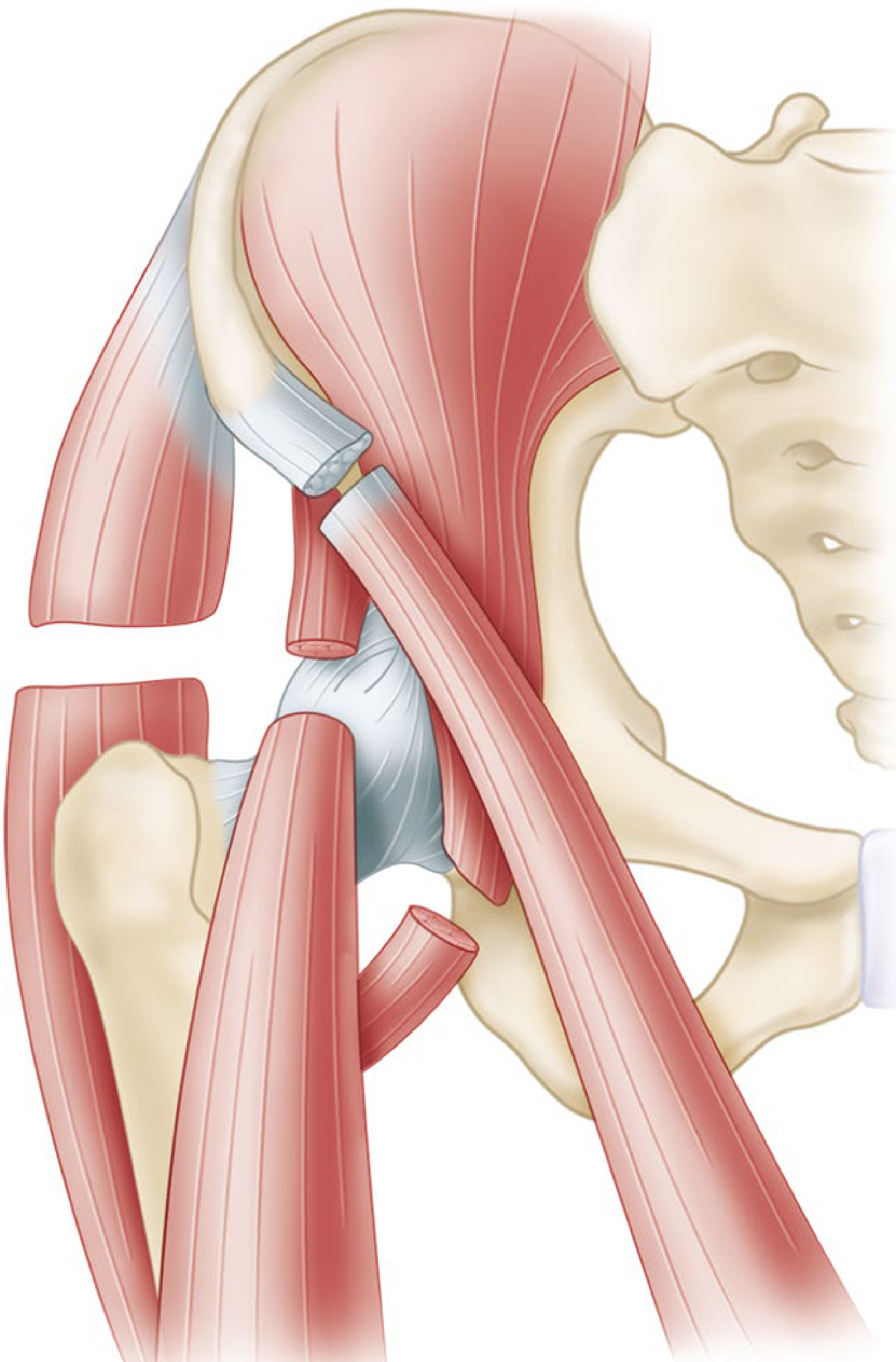 Complete release of flexion-abduction-external rotation contracture of hip showing ITB anatomy