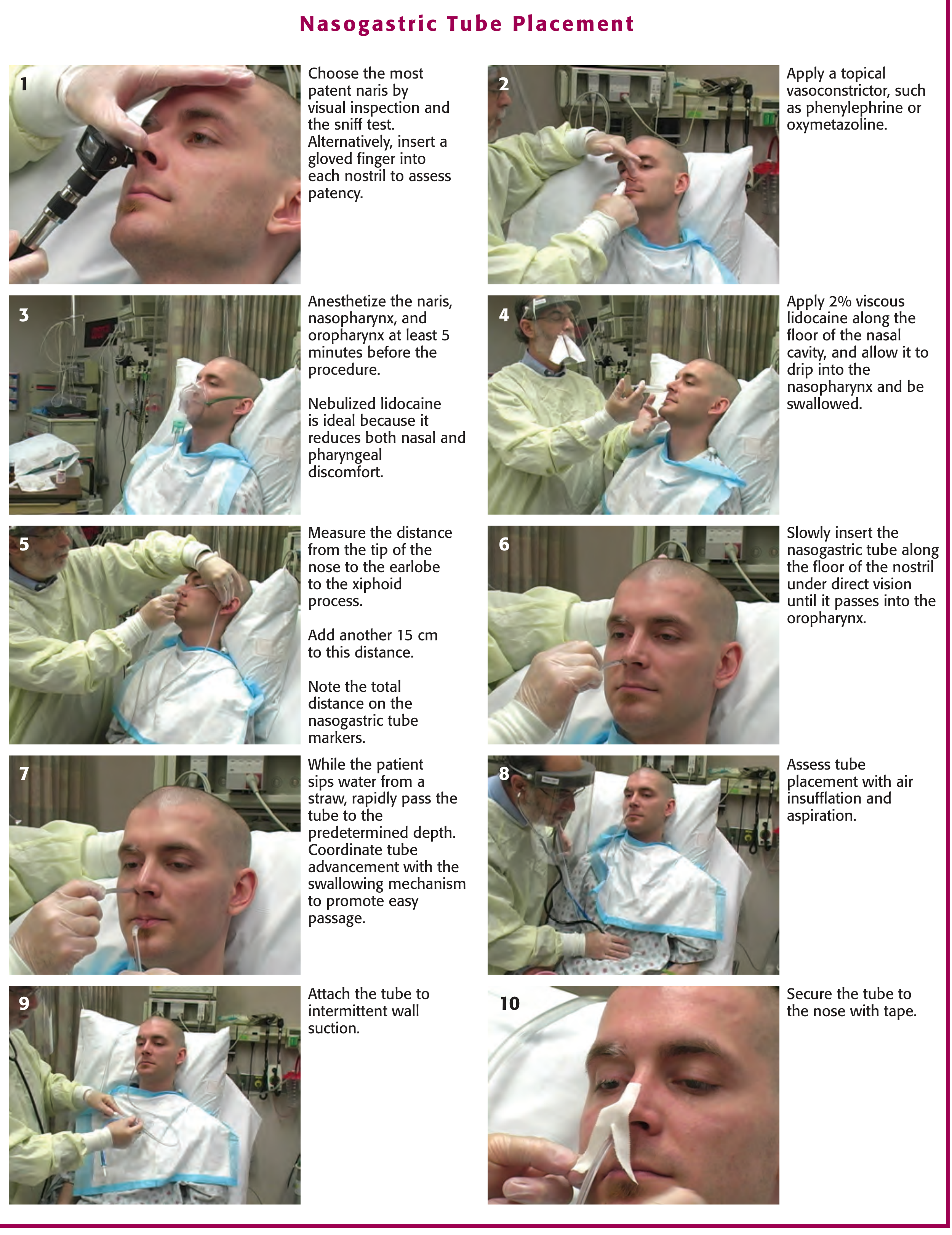 Nasogastric Tube Placement - 10-step illustrated guide