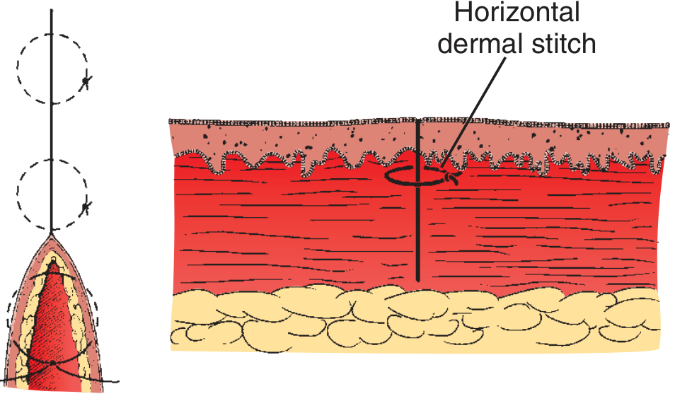Cross-sectional diagram showing horizontal dermal stitch placement within dermis layer