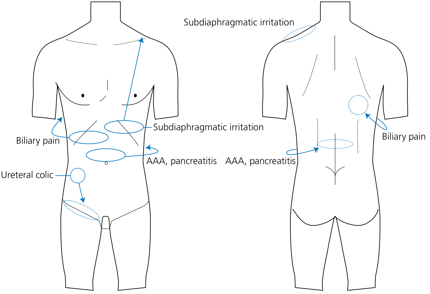 Referred pain patterns — biliary pain to right shoulder; AAA/pancreatitis to back; ureteric colic to groin/scrotum; subdiaphragmatic irritation to shoulder tip