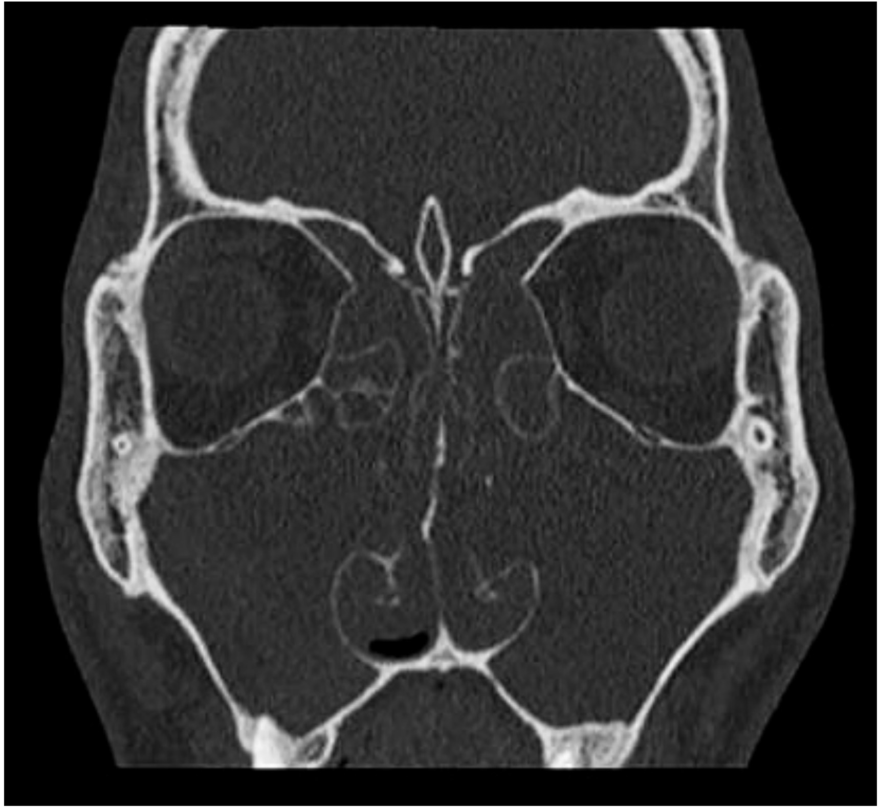 Coronal CT scan showing complete sinus opacification by nasal polyps (Figure 95.1 - Scott-Brown's)