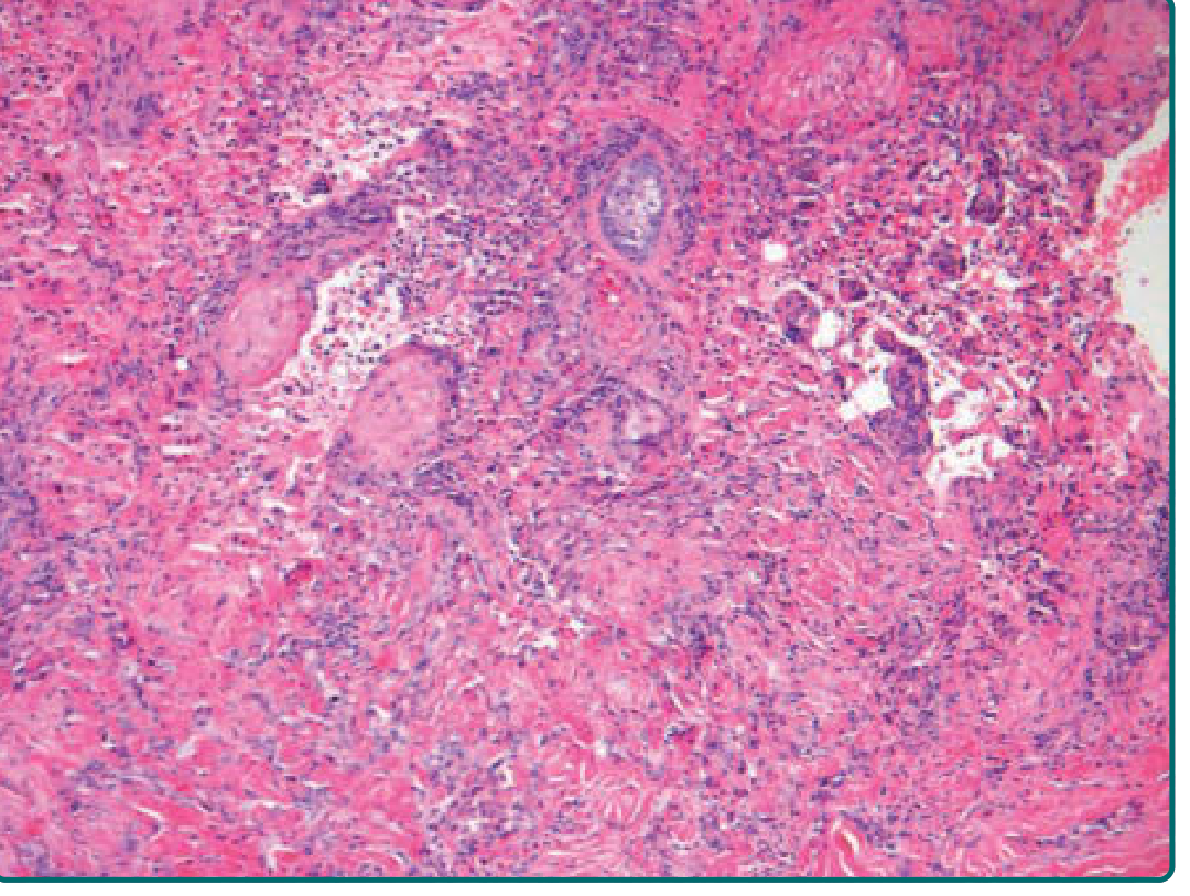 Angiosarcoma H&E (Fitzpatrick's). Atypical endothelial cells proliferating in the dermis with irregular vascular spaces.