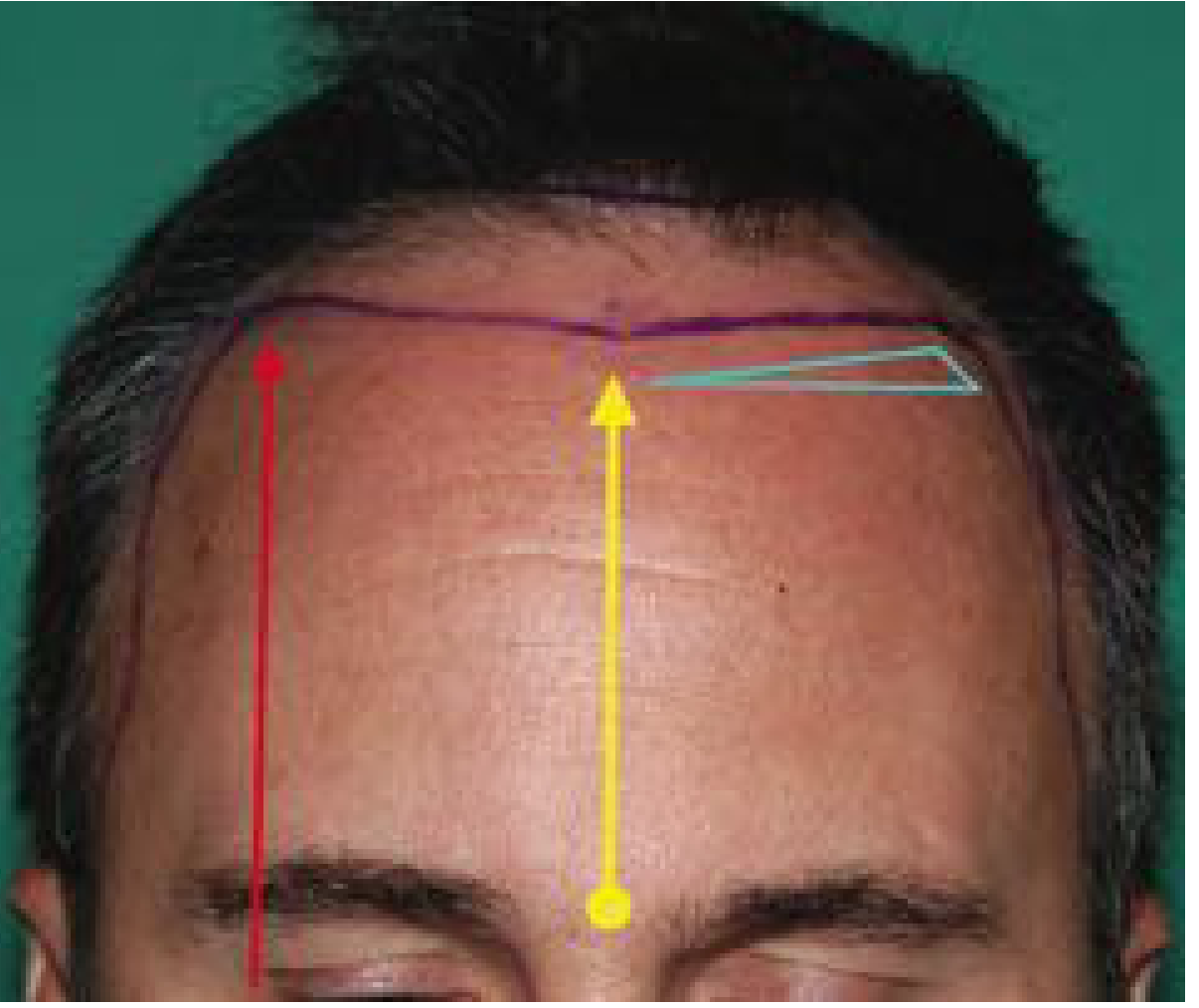 Hairline design landmarks - convex frontal hairline with glabella-to-trichion measurement and frontotemporal triangle