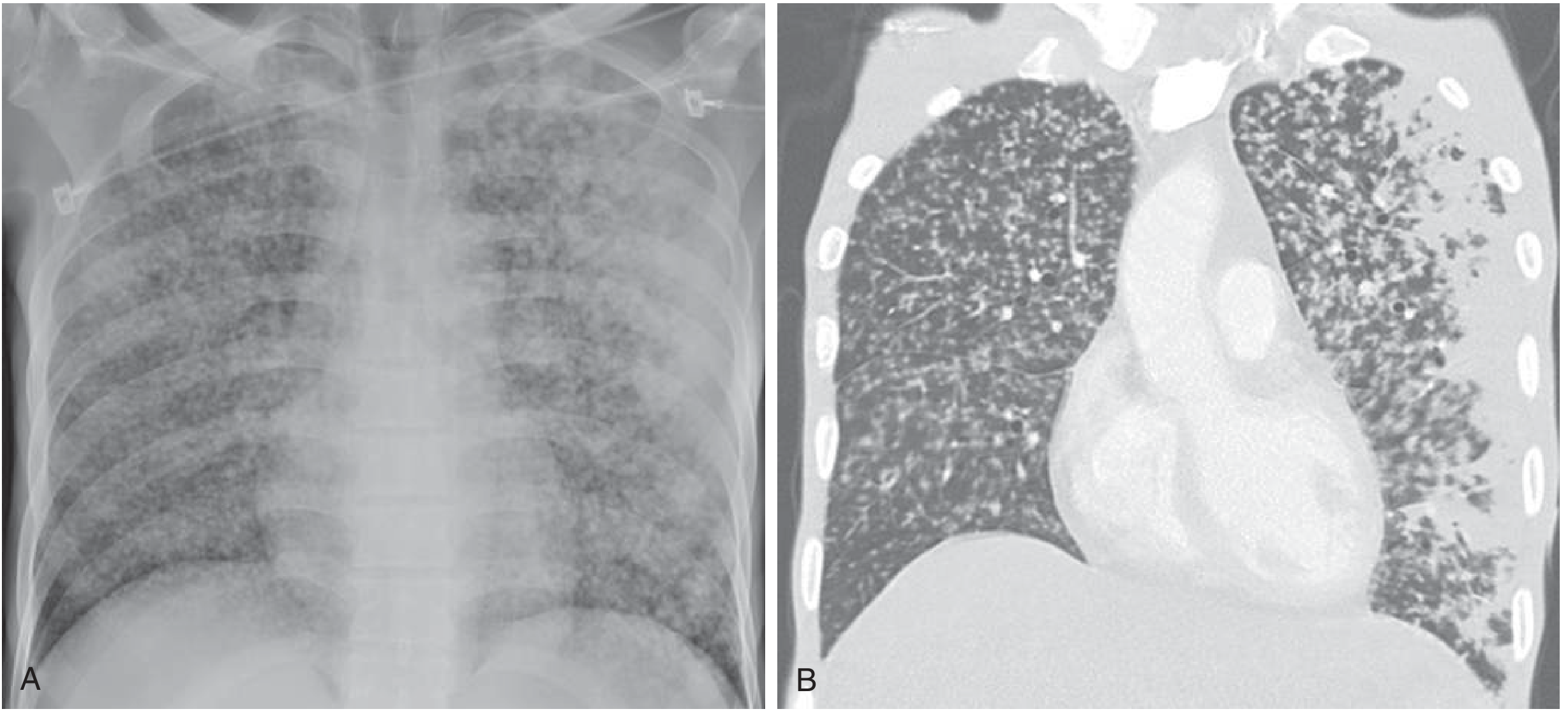 Miliary TB CXR and CT: bilateral diffuse micronodular shadowing in a 53-year-old man