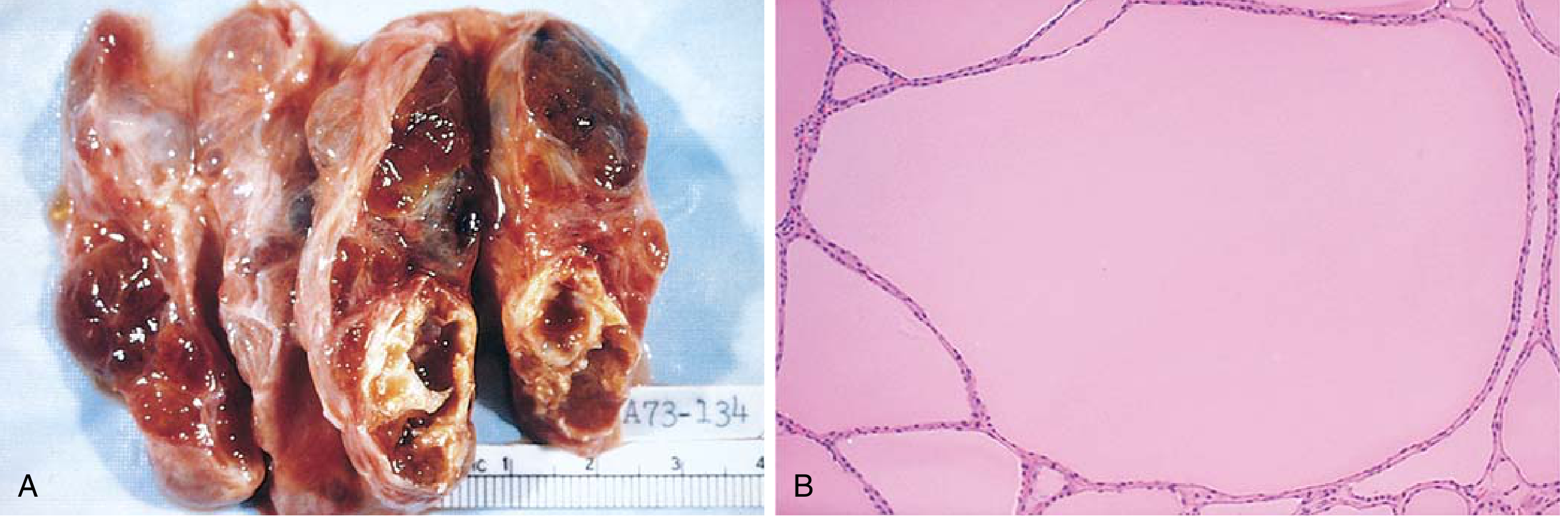 Multinodular goitre showing an enlarged nodular gland and colloid-filled follicles