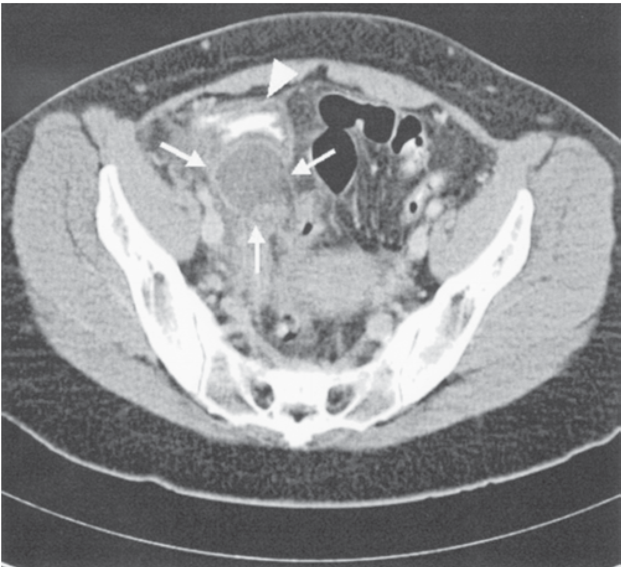Fig. 31-5 CT of perforated appendix with retrocecal abscess - Maingot's