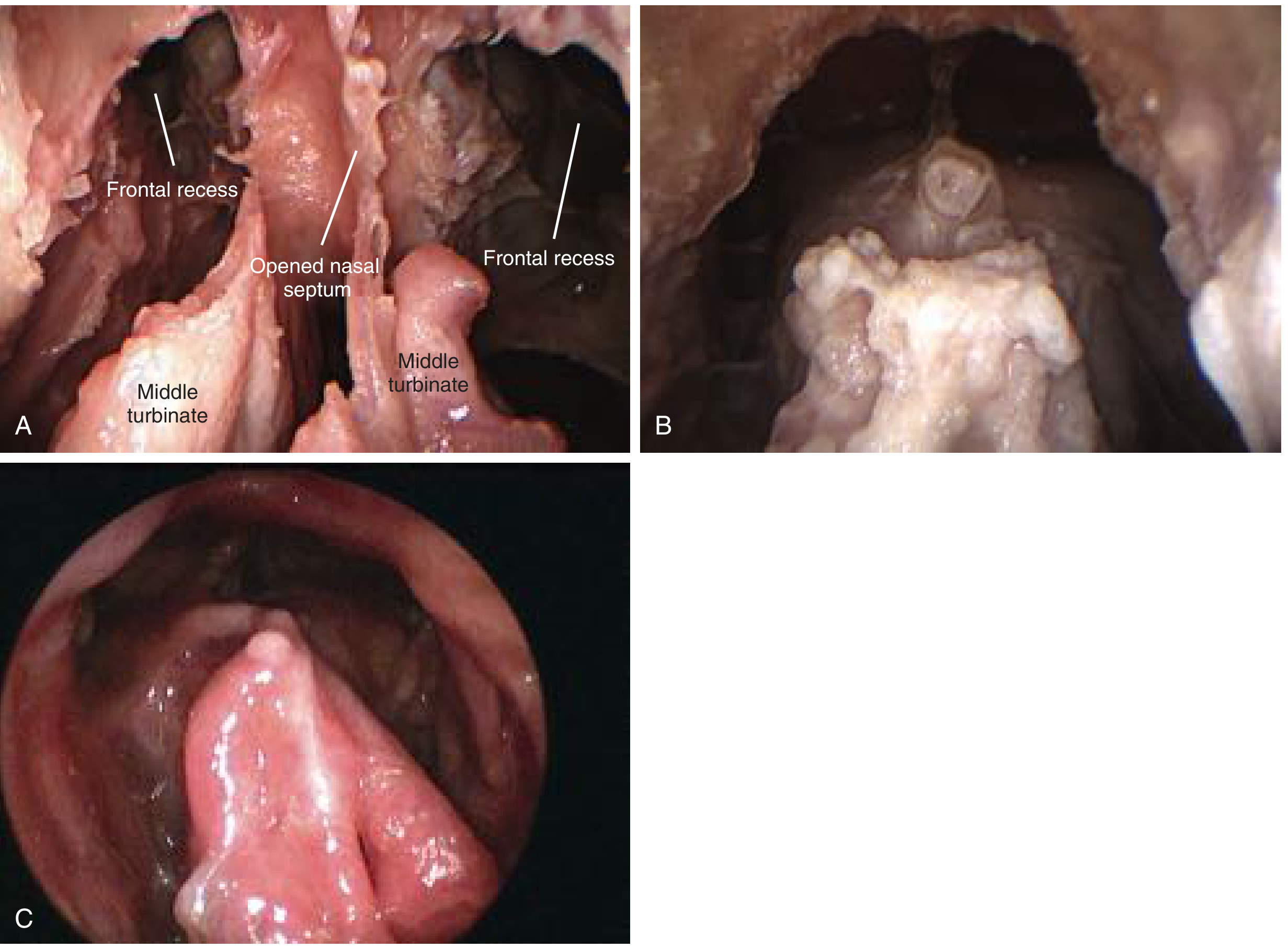 Draf III / EMLP procedure: (A) Bilateral frontal recesses with opened nasal septum; (B) completed neo-ostium; (C) neo-ostium patent 8 years post-operatively