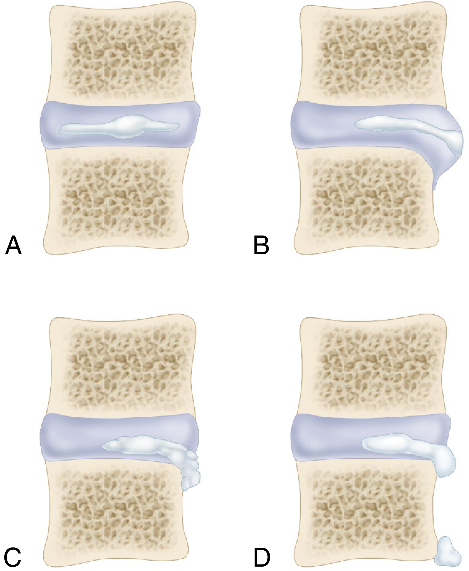 Types of disc herniation - A: Normal bulge, B: Protrusion, C: Extrusion, D: Sequestration
