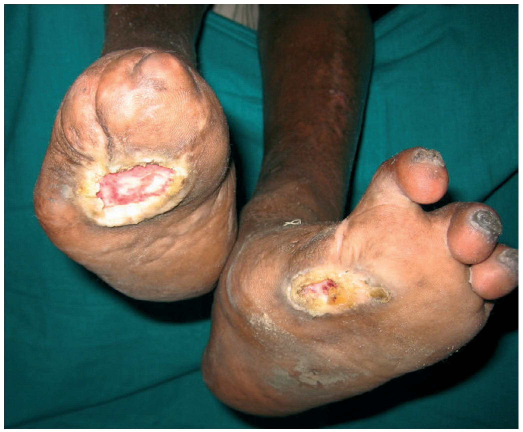 Bilateral trophic ulceration of the feet due to anaesthesia of the soles; note claw toes on the left foot