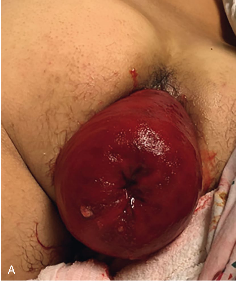 Congested full-thickness rectal prolapse showing characteristic circumferential folds