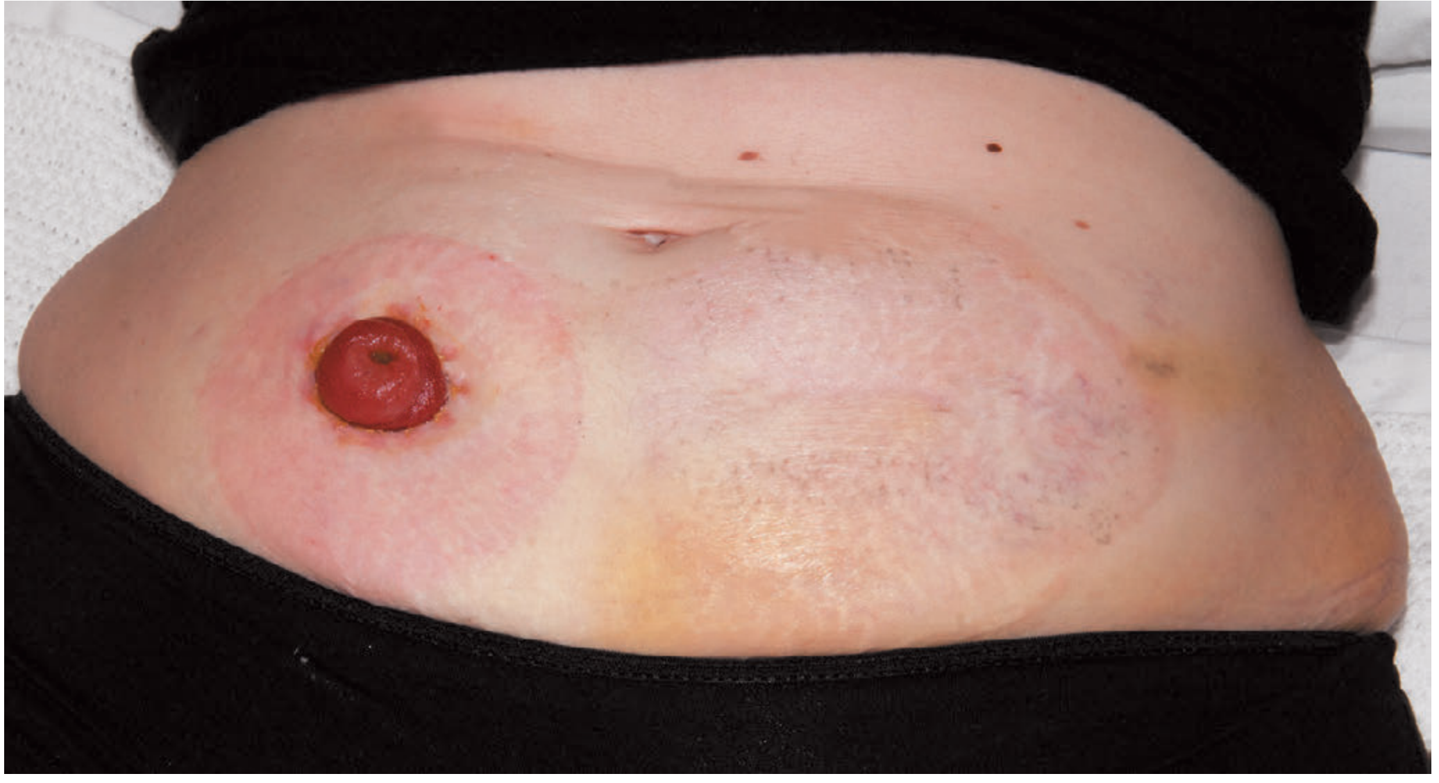 Spouted ileostomy in the right iliac fossa