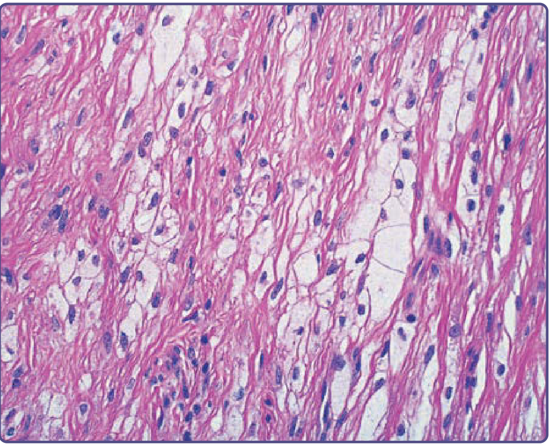 Foam cells from a tuberous xanthoma - H&E showing large vacuolated macrophages amid collagen bundles
