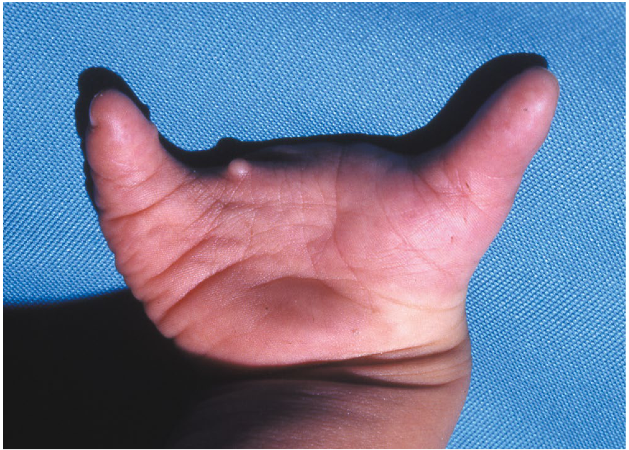 Atypical cleft hand - U-shaped deficiency leaving only thumb and little finger