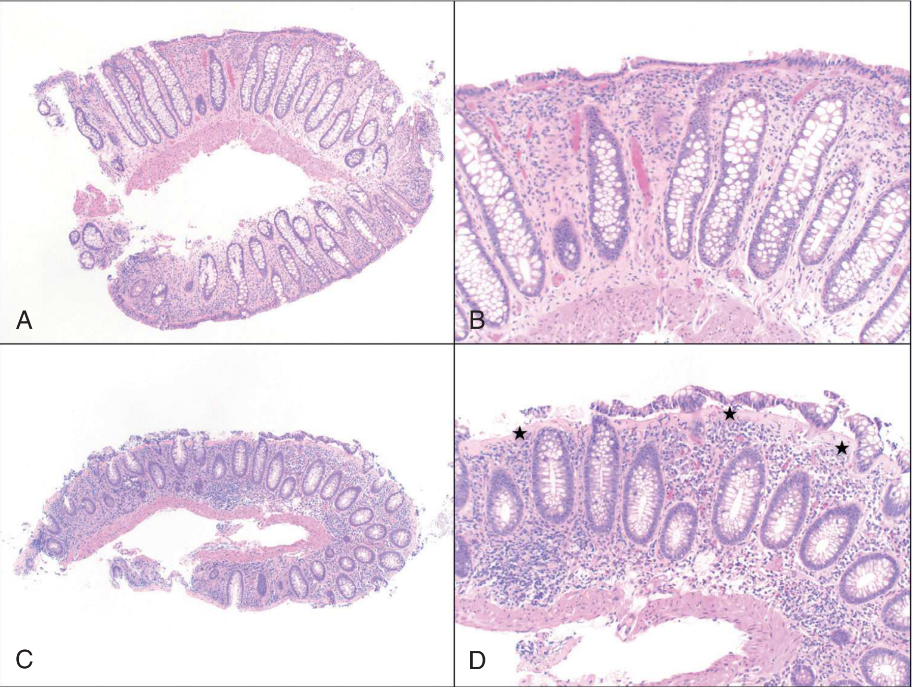 Microscopic colitis histology - collagenous colitis, rectum vs right colon biopsies showing thickened subepithelial collagen layer